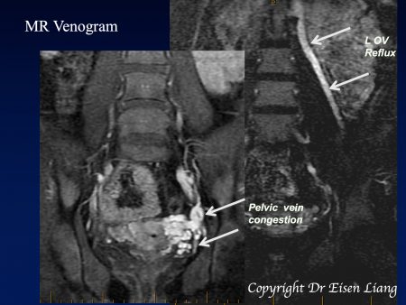 An MRI can showing congested pelvic veins and the refluxing ovarian vein.