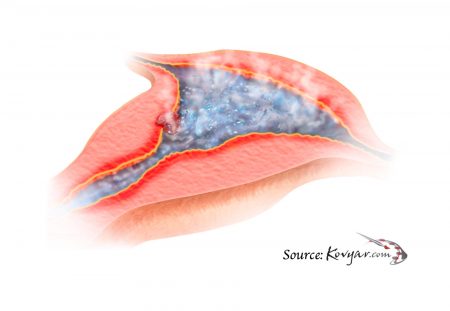 Endometrial Ablation destroys the inner lining of the uterus.