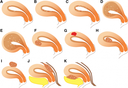 Classification of Adenomyosis
