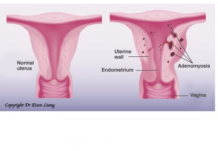 Normal vs adenomyosis uterus.