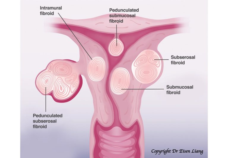 Different fibroids on the uterus.