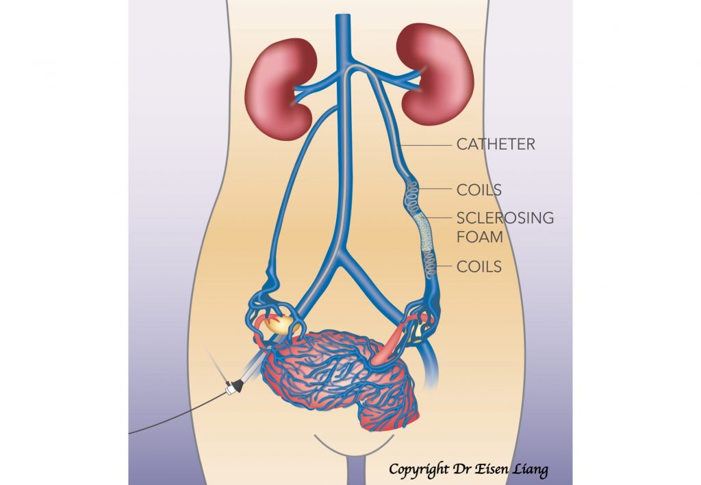 The embolisation procedure blocks the refluxing ovarian vein to stop backflow down the pelvis.