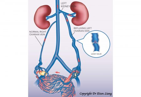 Reflux in the ovarian vein, allowing backflow of venous blood into pelvis.