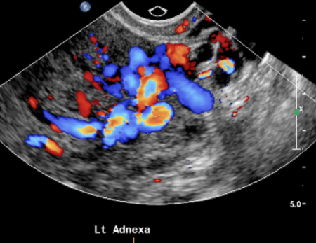 Pelvic ultrasound detects dilated and congested pelvic varicose veins.