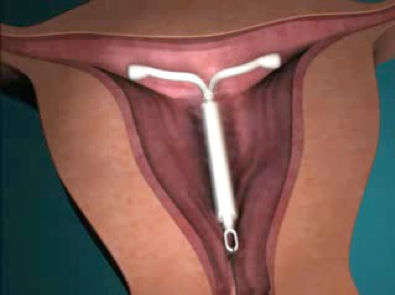 Mirena IUD for relieving the symptoms of heavy bleeding and period pain.