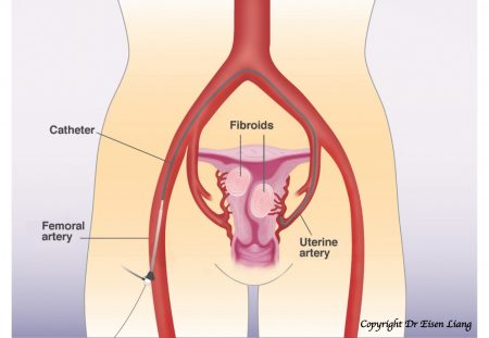 A tiny nick in the skin is made and a 1 - 2 mm catheter is then inserted.