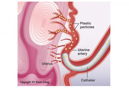 During UFE, particles injected will block some of the normal uterine vessels.