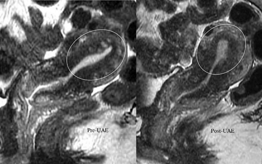 Pre-UAE MRI confirmed adenomyosis, showing multiple bright foci in the wall of the uterus.