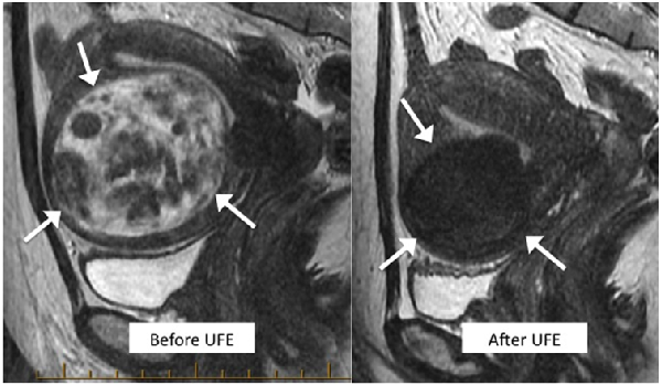 MRI of shrinking fibroid before and After UFE.