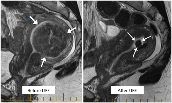MRI showing fibroid shrank from 87ml to only 2ml.