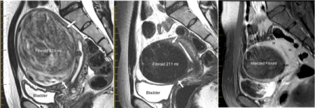 UFE Shrinking Fibroid