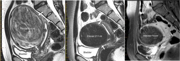 MRI shows reduction of fibroid volume went from 533ml to 211ml at six-month progress. 