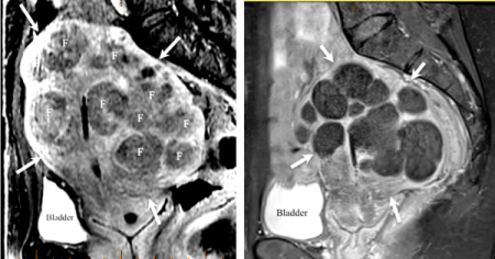 Fibroid will shrink 60% of its volume.