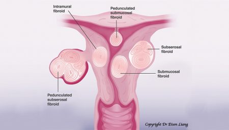 What Are Fibroids? - Sydney Fibroid Clinic