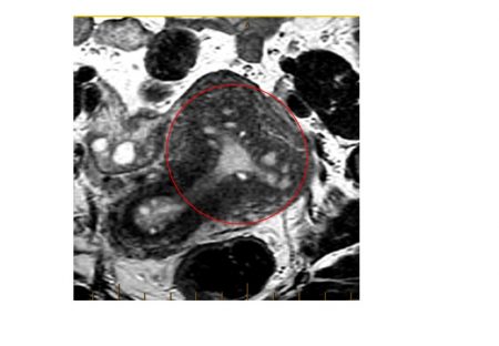 Adenomyosis MRI