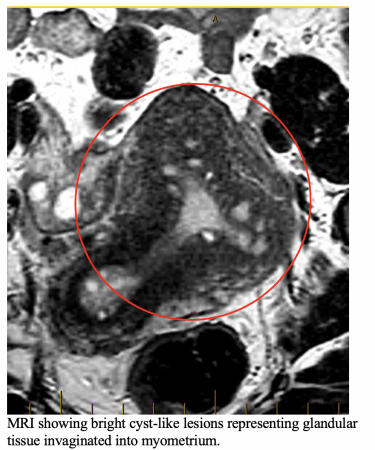 MRI showing bright cyst-like lessions representing grandular tissue invaginated into myometrium.