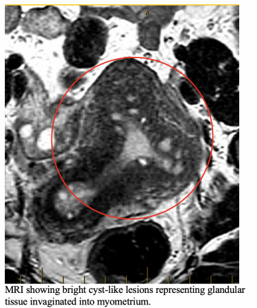 MRI of Adenomyosis