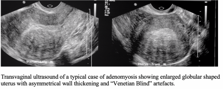 Transvaginal ultrasound showing enlarged globular shaped uterus.