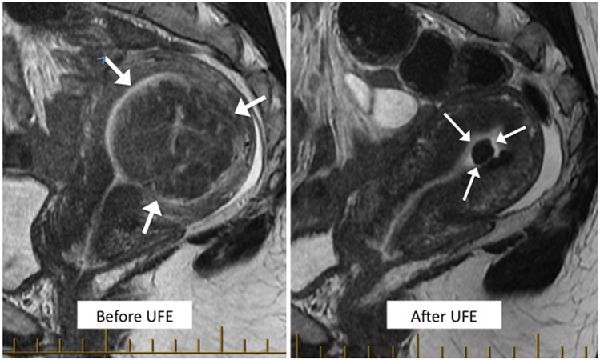 Before and after UFE MRI showing fibroid shrank from 87ml to only 2ml.