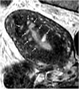 MRI Adenomyosis