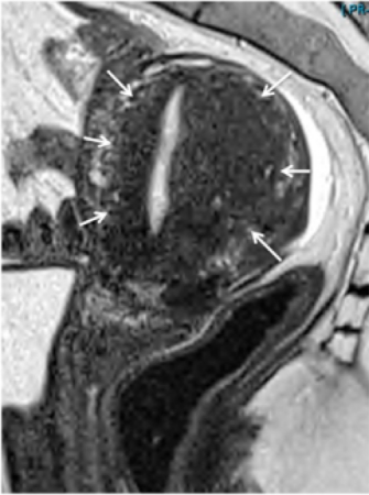 MRI Adenomyosis Junctional Zone Thickening
