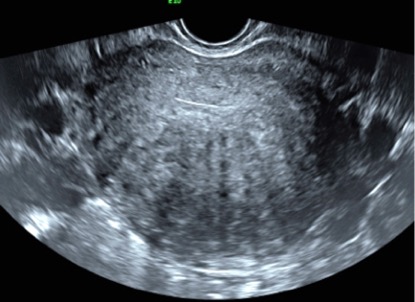 Ultrasound Adenomyosis