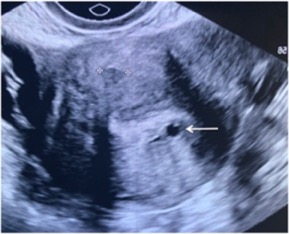 Ultrasound Adenomyosis