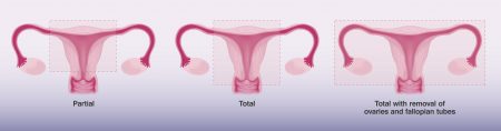 The different types of hysterectomies.