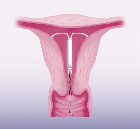 Mirena IUD