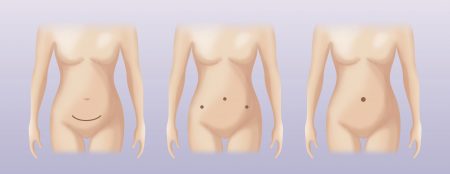 Different ways to remove the uterus: open abdominal, laparoscopic, robotic single-port hysterectomy.