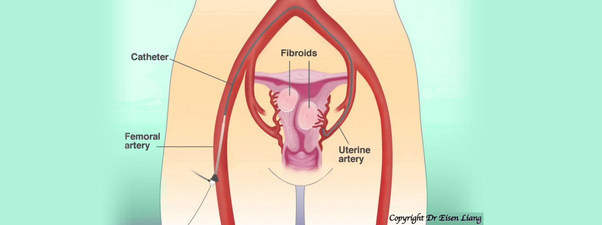 UFE (Uterine Fibroid Embolisation) to shrink fibroids and alleviate fibroid symptoms.