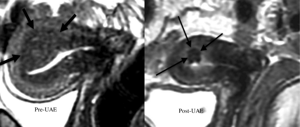 Post-embolisation MRI at six months showed a dark area of scar tissue.