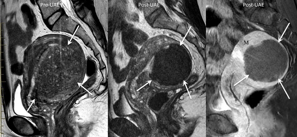 Pre-UAE MRI vs post-UAE MRI shows scarring of focal adenomyosis and shrinkage from 272ml to 115ml. 