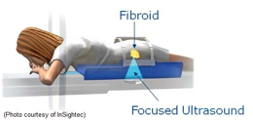 MRgFU for Fibroids