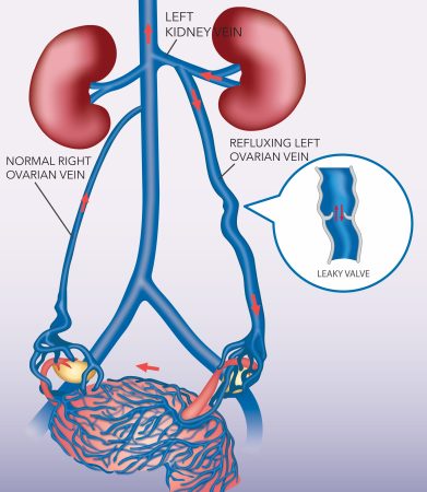 Pelvic Congestion Syndrome