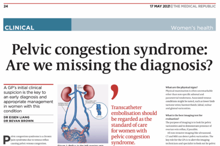 Pelvic Congestion Syndrome